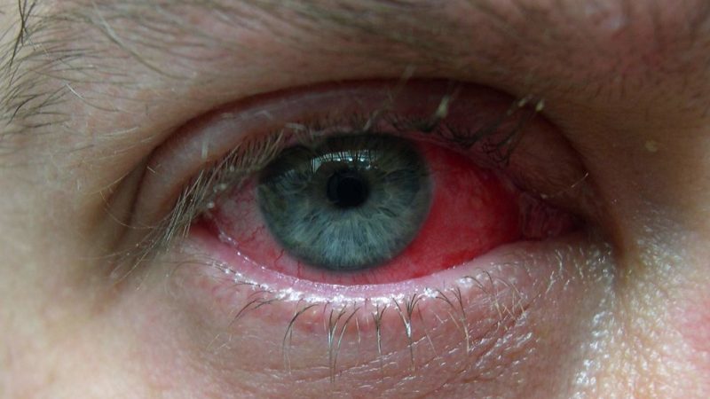 Boererate vir Pink Eyes: Verligting vir Jou Oë