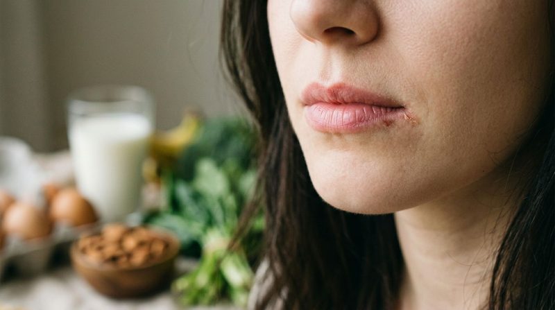 Vitamien B2-tekort en gebarste lippe: wat dit kan beteken