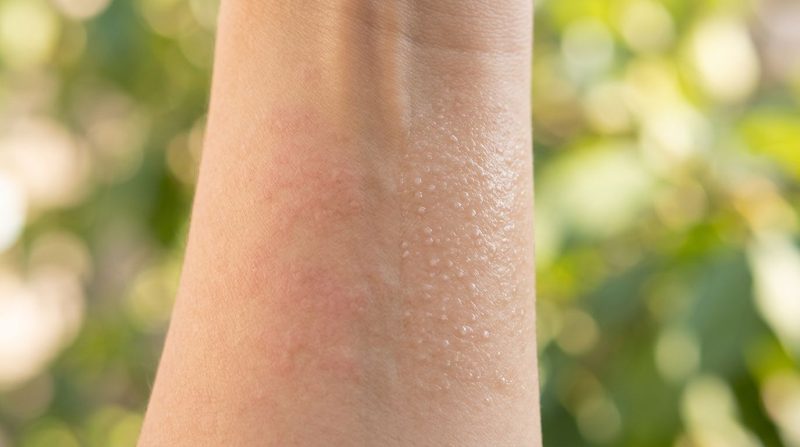 Sonallergie of hitteuitslag? So sien jy die verskil